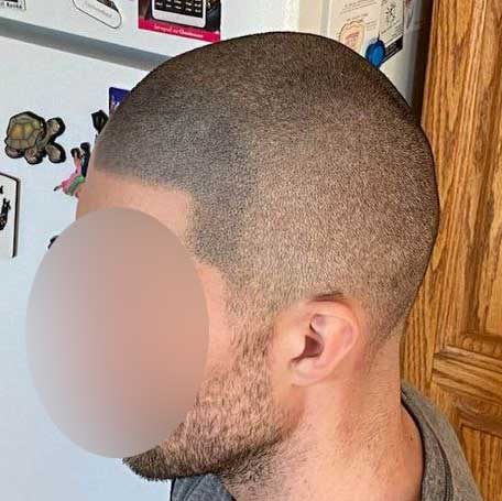 Top 4 Reasons for scalp micropigmentation regrets | 6 Solutions