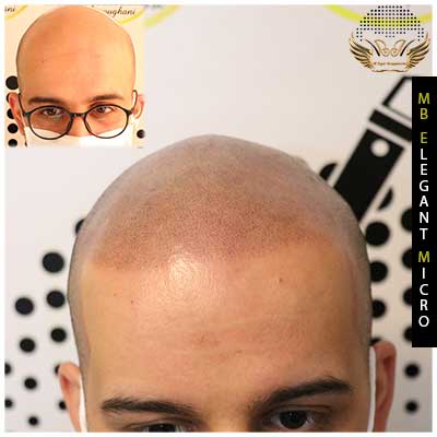 Scalp micropigmentation for bald head
