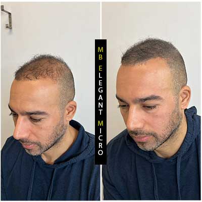 Do you have to shave your head for scalp micropigmentation