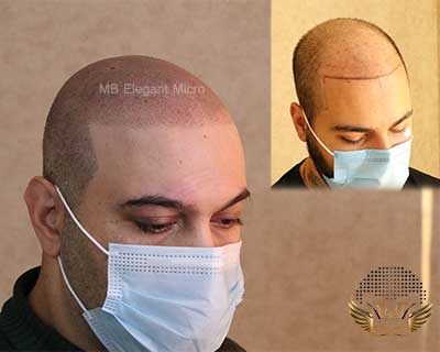Advantages and disadvantages of scalp micropigmentation