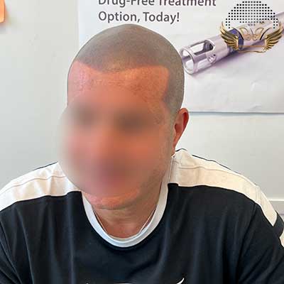 Scalp micropigmentation after 5 years | before and after photos