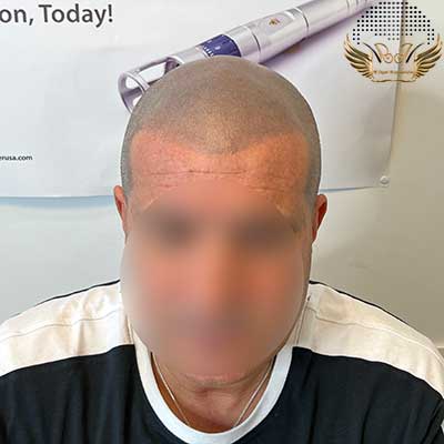 Scalp micropigmentation after 5 years | before and after photos