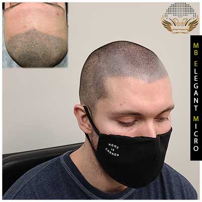 Scalp micropigmentation for bald head