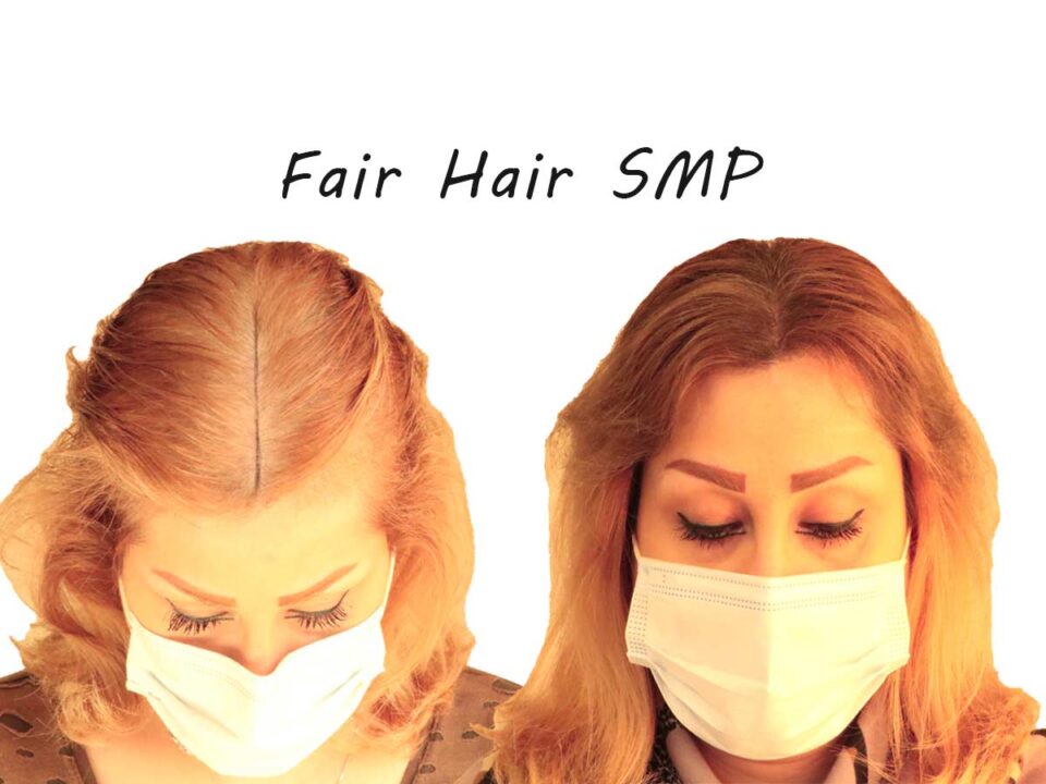 scalp micropigmentation for fair hair