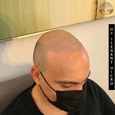 Grown-out hair with scalp micropigmentation