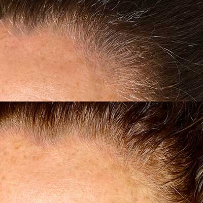 Hairline microblading | Scalp microblading in Vancouver