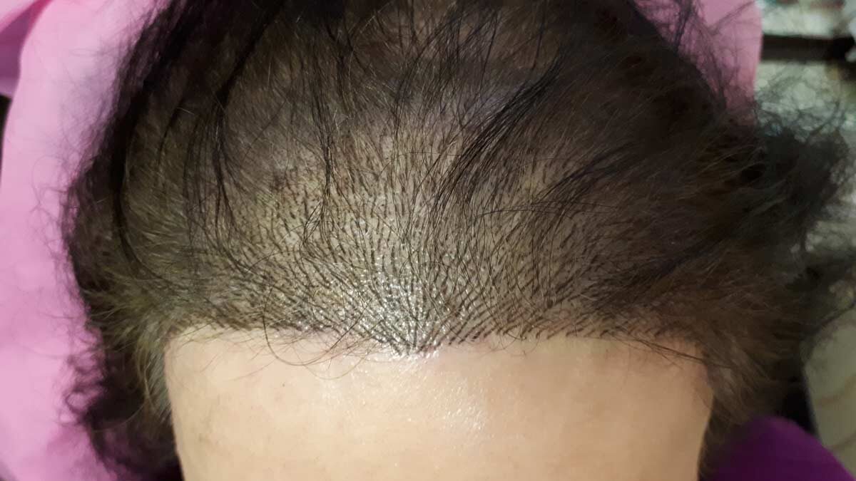 hairline microblading north vancouver