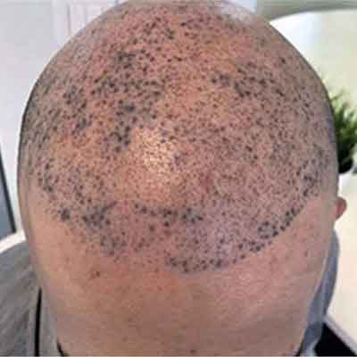 The differences between scalp micropigmentation and tattoos?