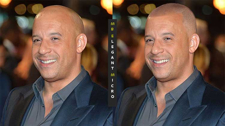 scalp micropigmentation for celebrities