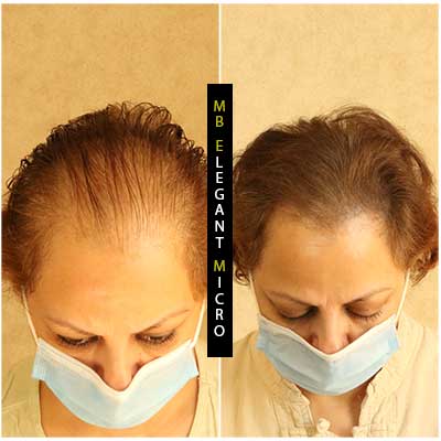 Women scalp micropigmentation north vancouver