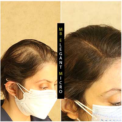 Women scalp micropigmentation north vancouver