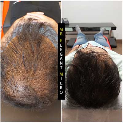 Men scalp micropigmentation north vancouver
