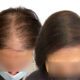 What is scalp micropigmentation